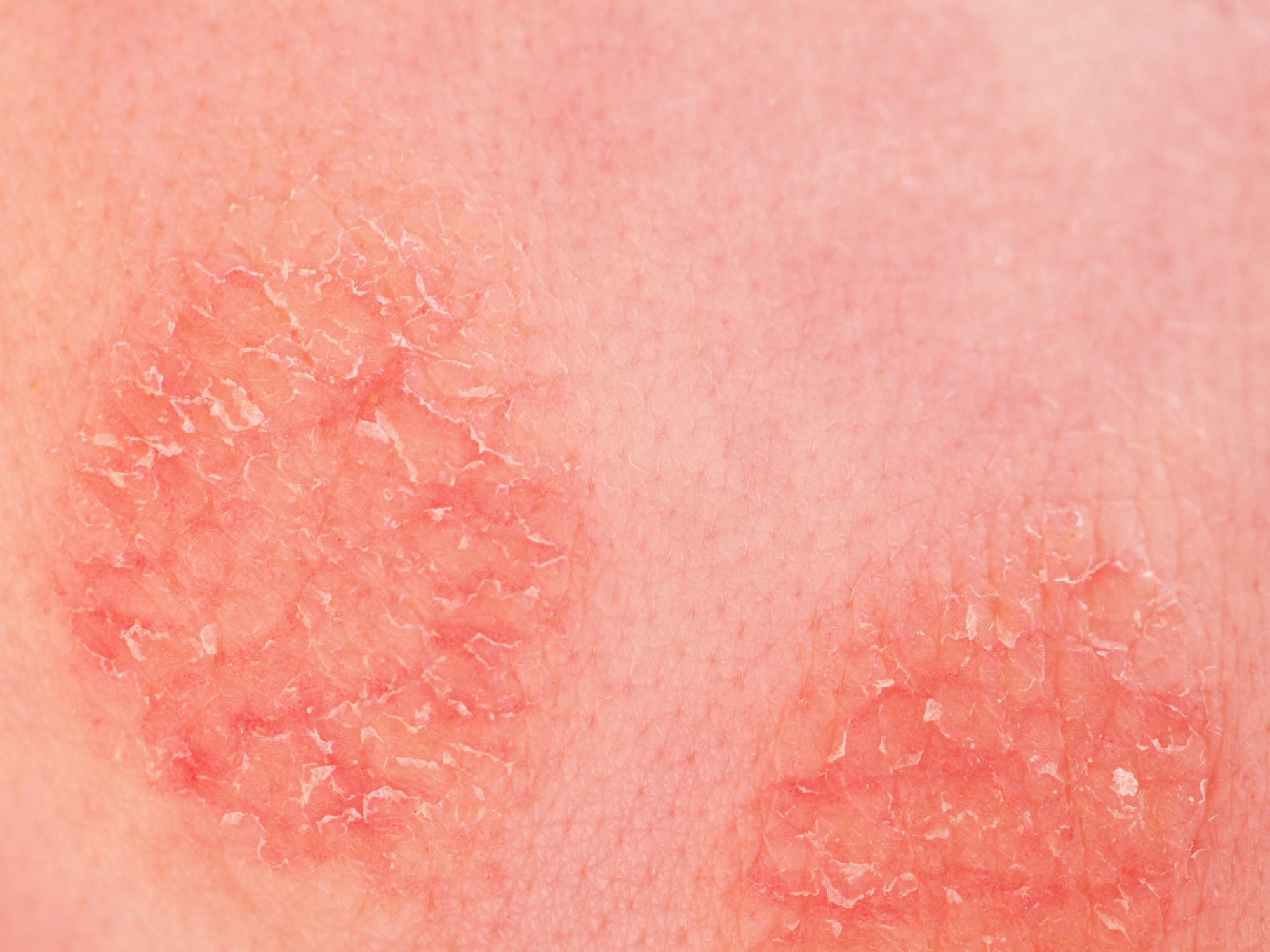 Eczema Circular Rash