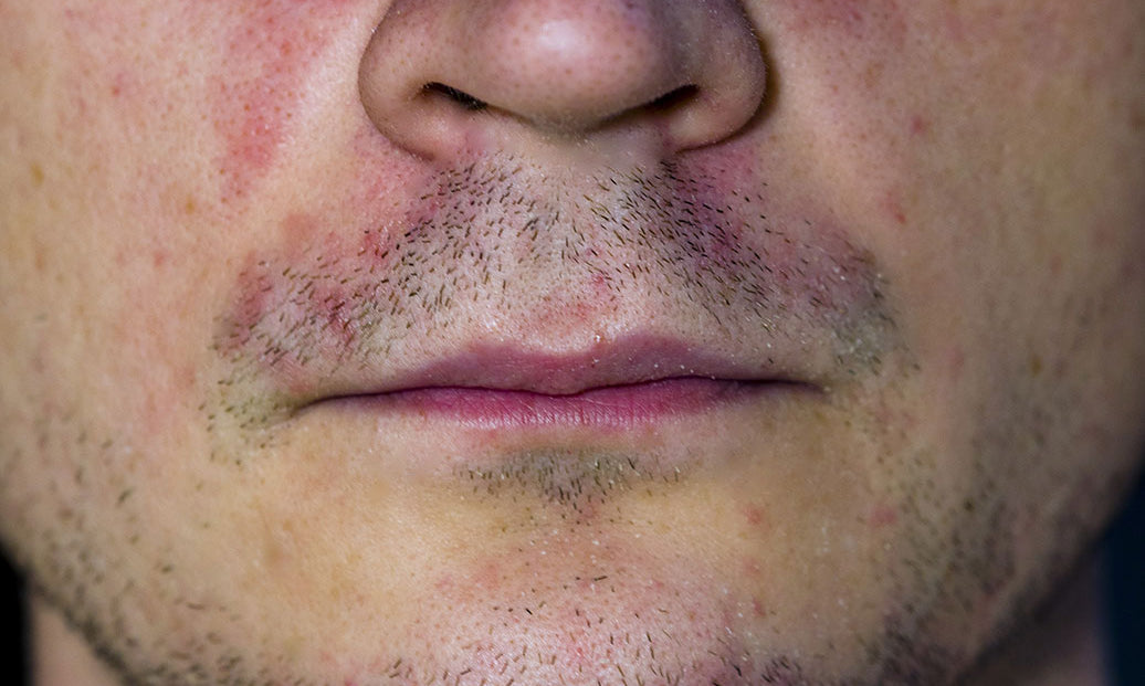 Does Perioral Dermatitis Ever Go Away?