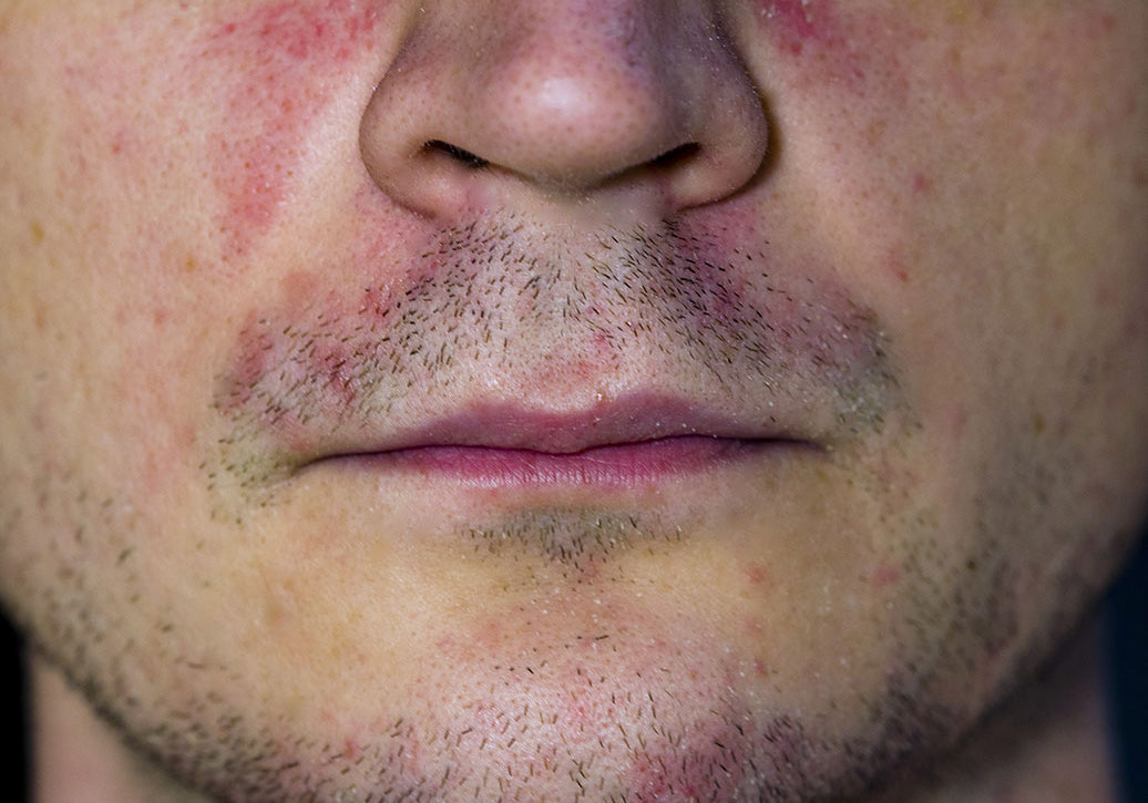 Does Perioral Dermatitis Ever Go Away?
