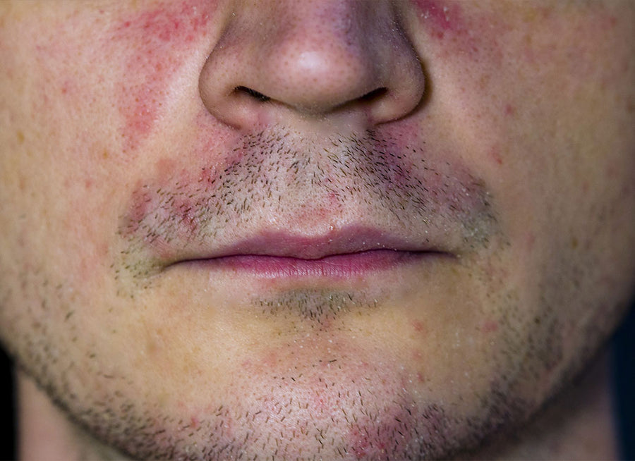 Does Perioral Dermatitis Ever Go Away?