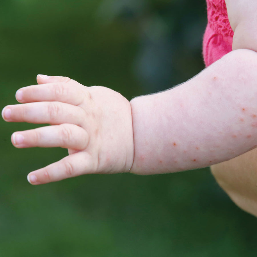 Is Your Eczema Cream Giving You An Itchy Rash?