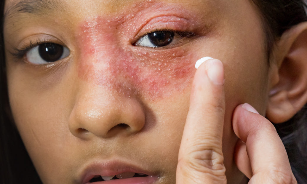 Young woman with dermatitis around the eyes