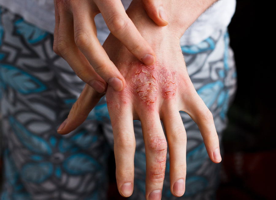 dry, red skin on the back of a hand