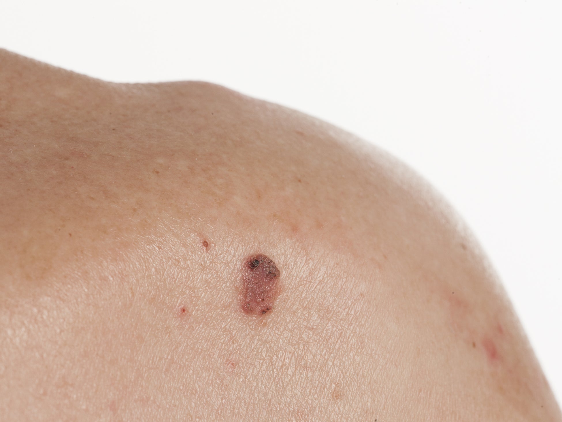 How Can You Tell The Difference Between Squamous Cell Carcinoma And Ac