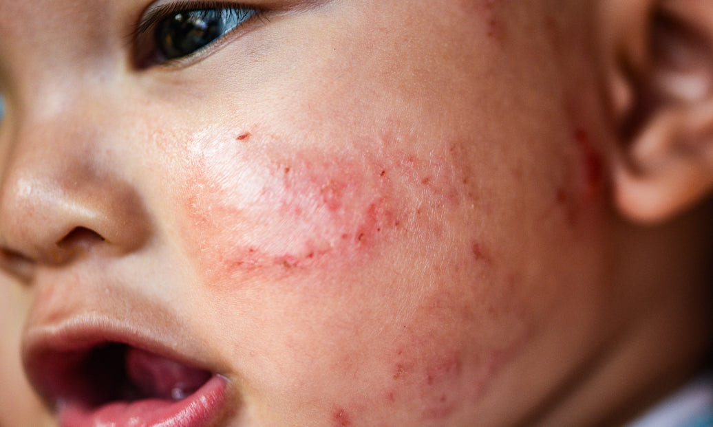 eczema on a babies face