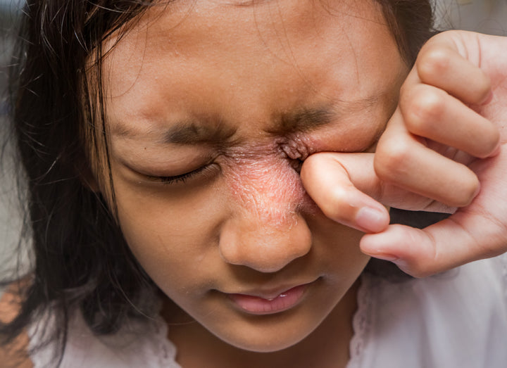 Young person with Periocular Dermatitis, rubbing their eye
