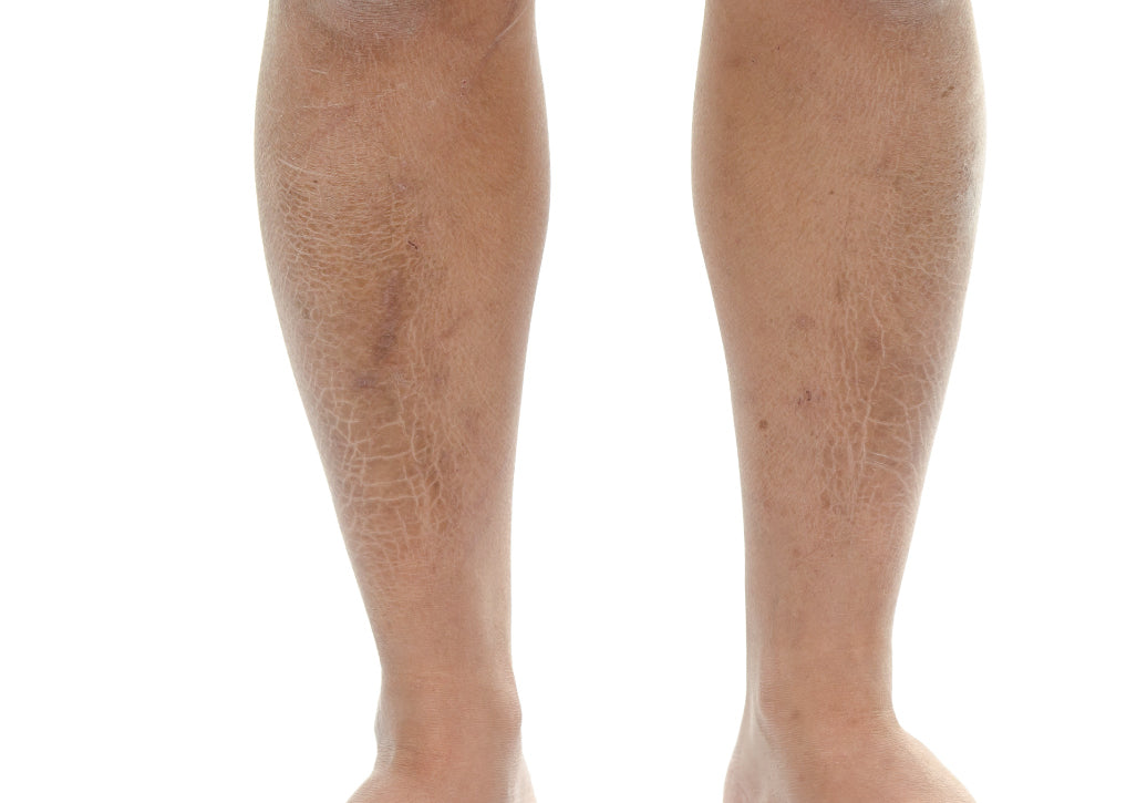 scaly legs