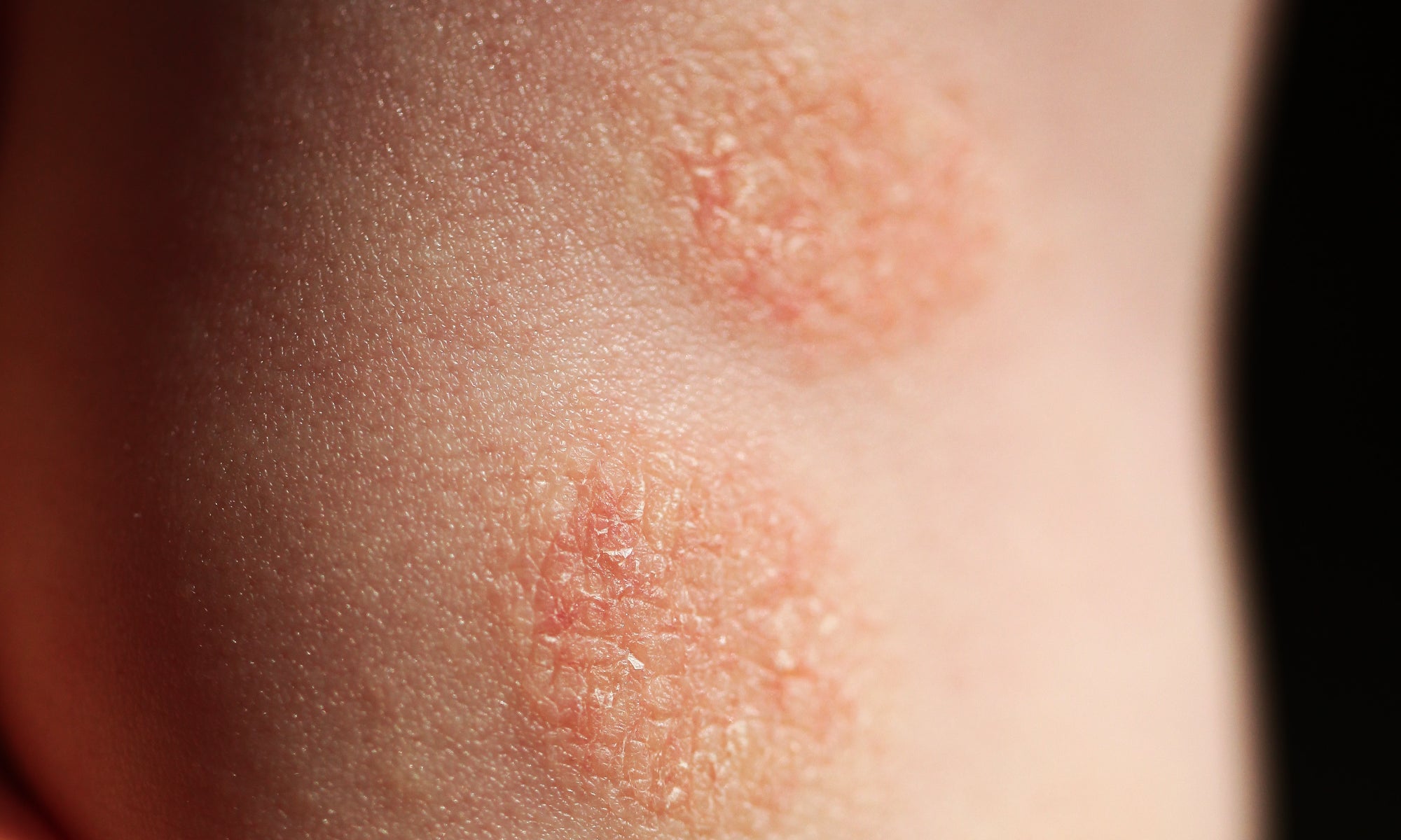 An example of nummular eczema