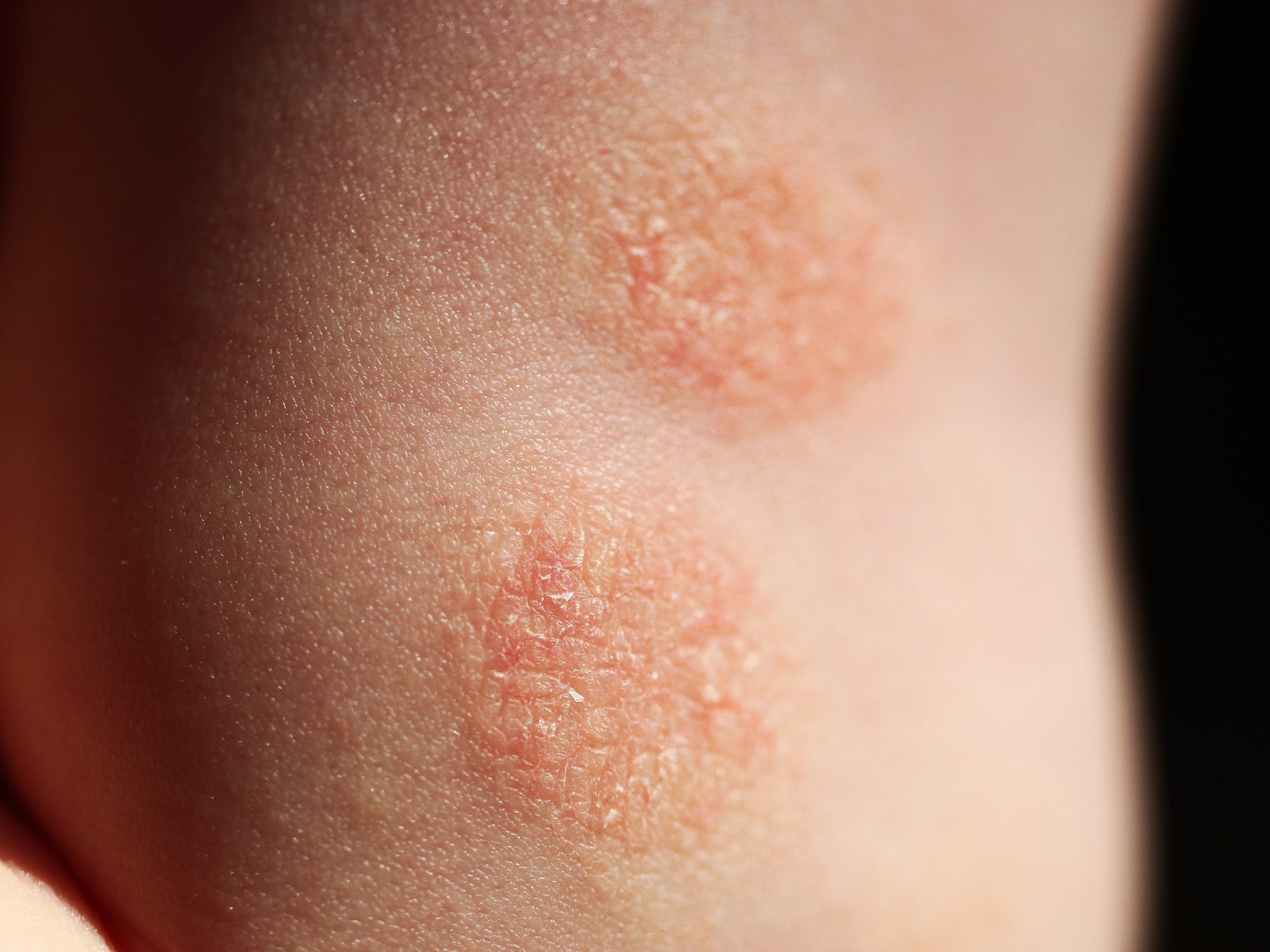 An example of nummular eczema