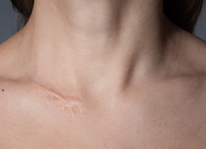 a scar on a neck