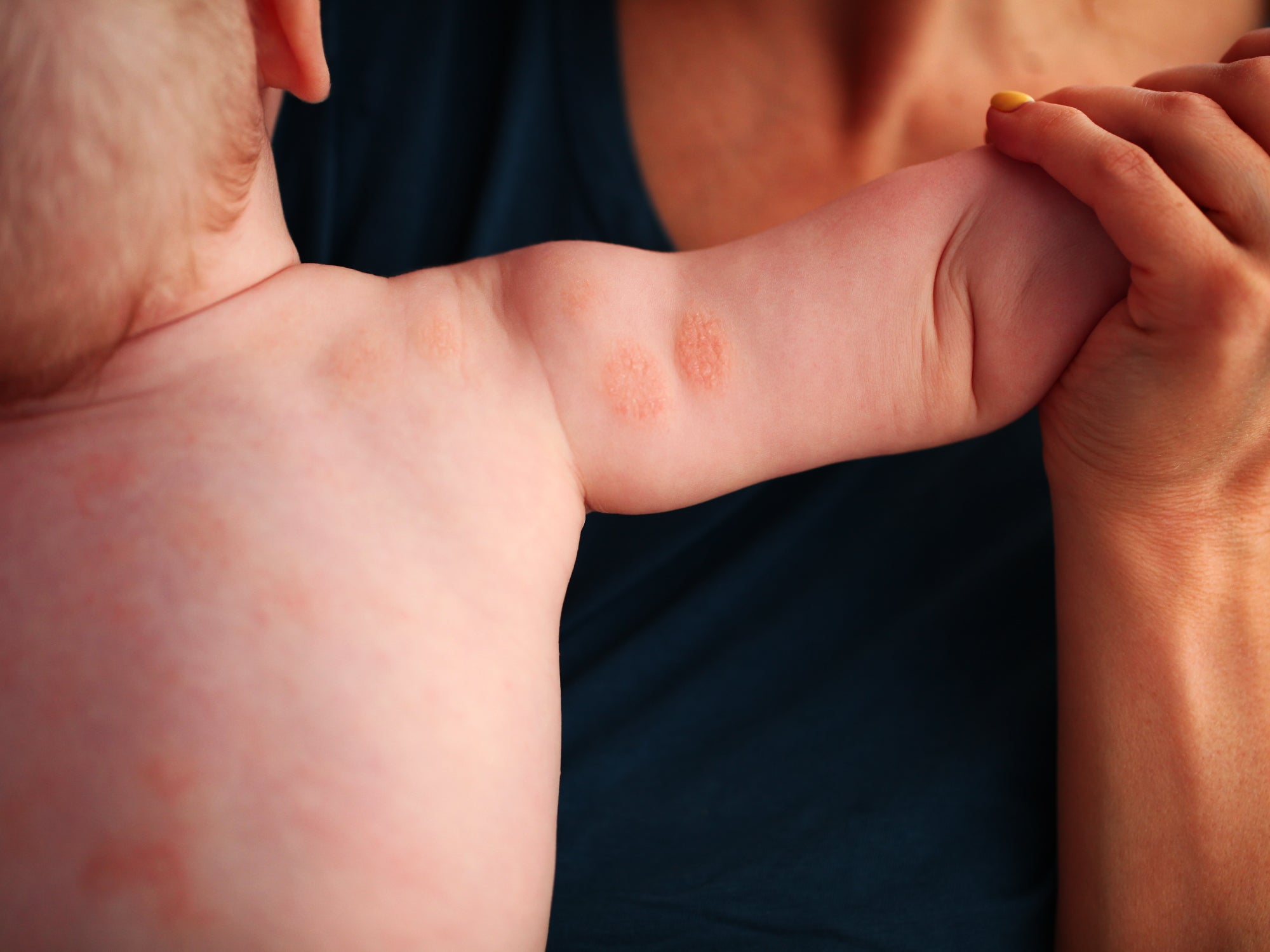 Some discoid eczema on the back of a babies arm