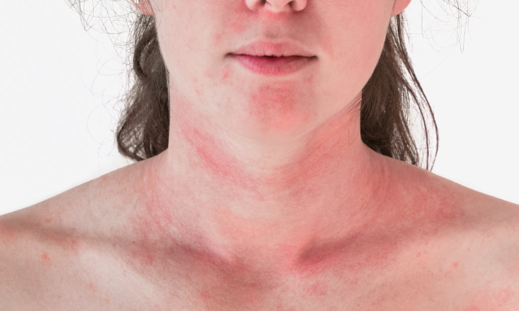 Example of skin flaring up and going red around the neck