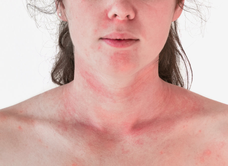 Example of skin flaring up and going red around the neck