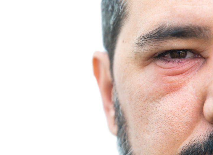 Blepharitis around the eye