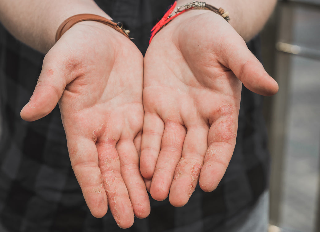 Dyshidrosis on palms of hands