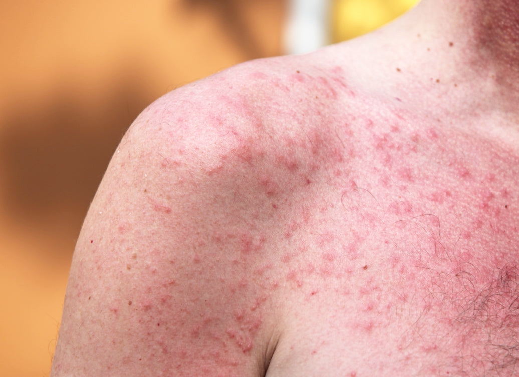 Polymorphic Light Eruption on shoulders