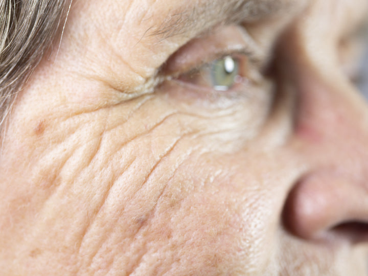 Actinic Keratosis on the side of the face and around the eye