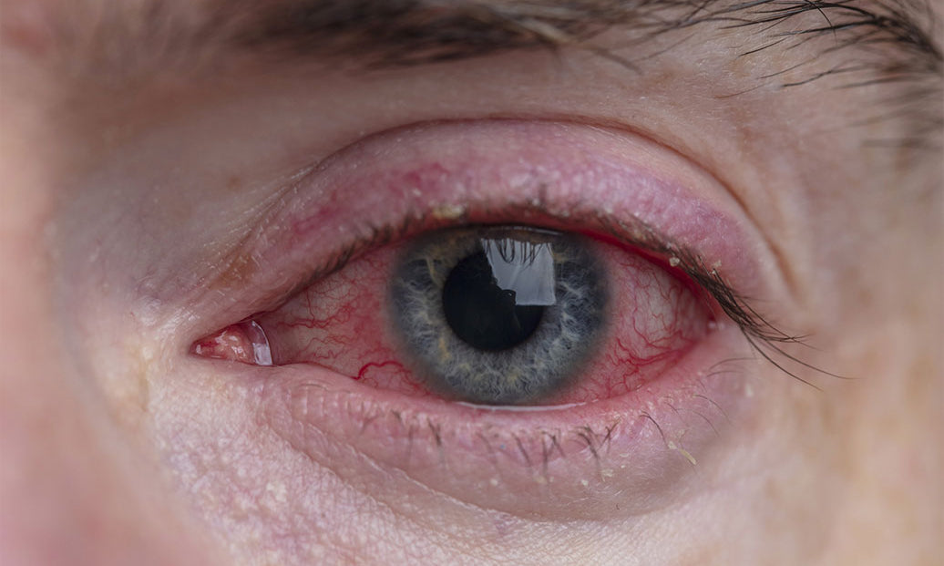 Is Blepharitis Bacterial Or Viral?