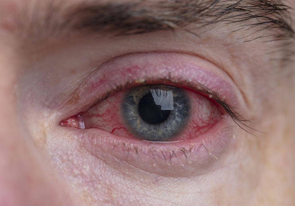 Is Blepharitis Bacterial Or Viral?