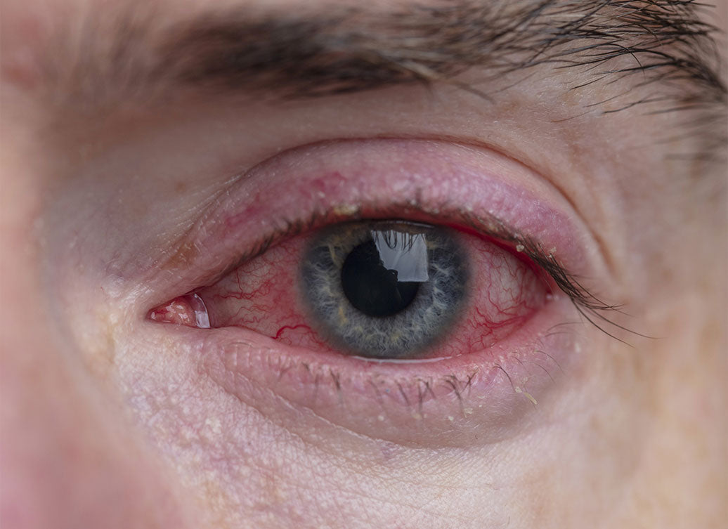 Is Blepharitis Bacterial Or Viral?