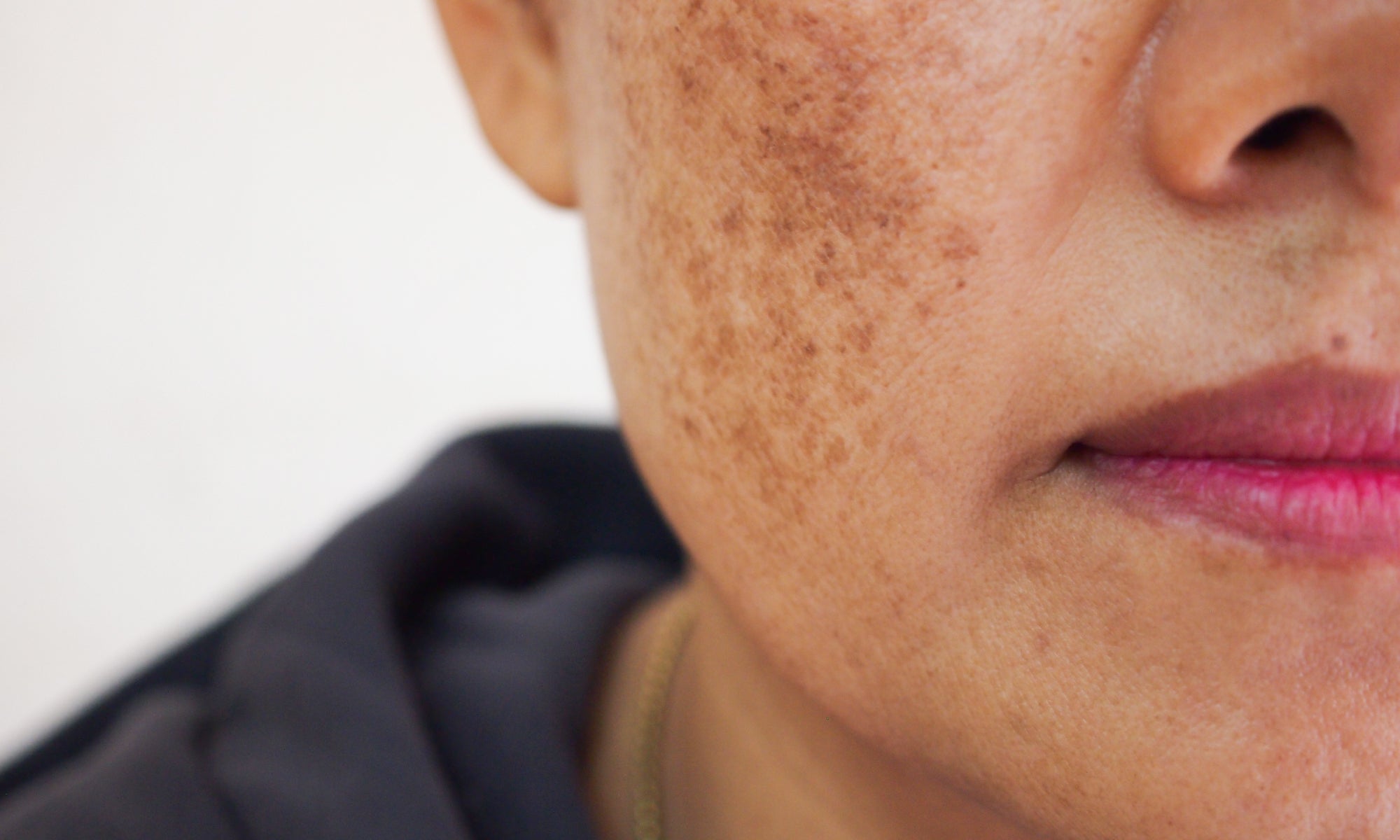 What's The Best Treatment For Melasma?