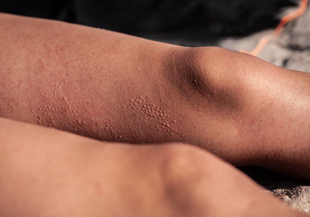 Polymorphous Light Eruption on legs