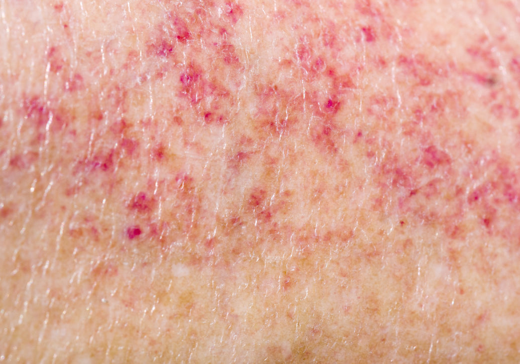 Close up of polymorphic light eruption on the skin