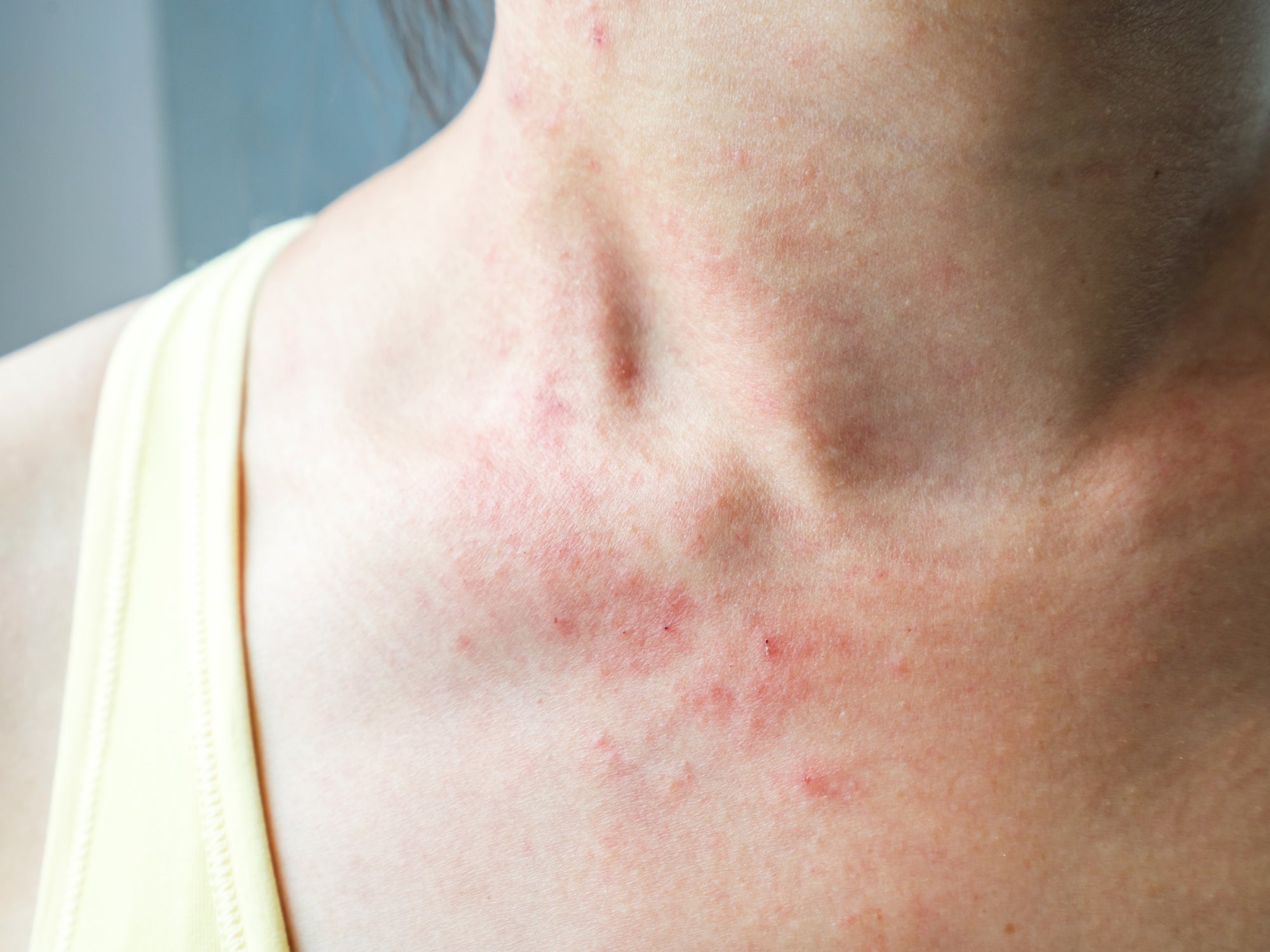 What Can You Put On Chemo Rash?