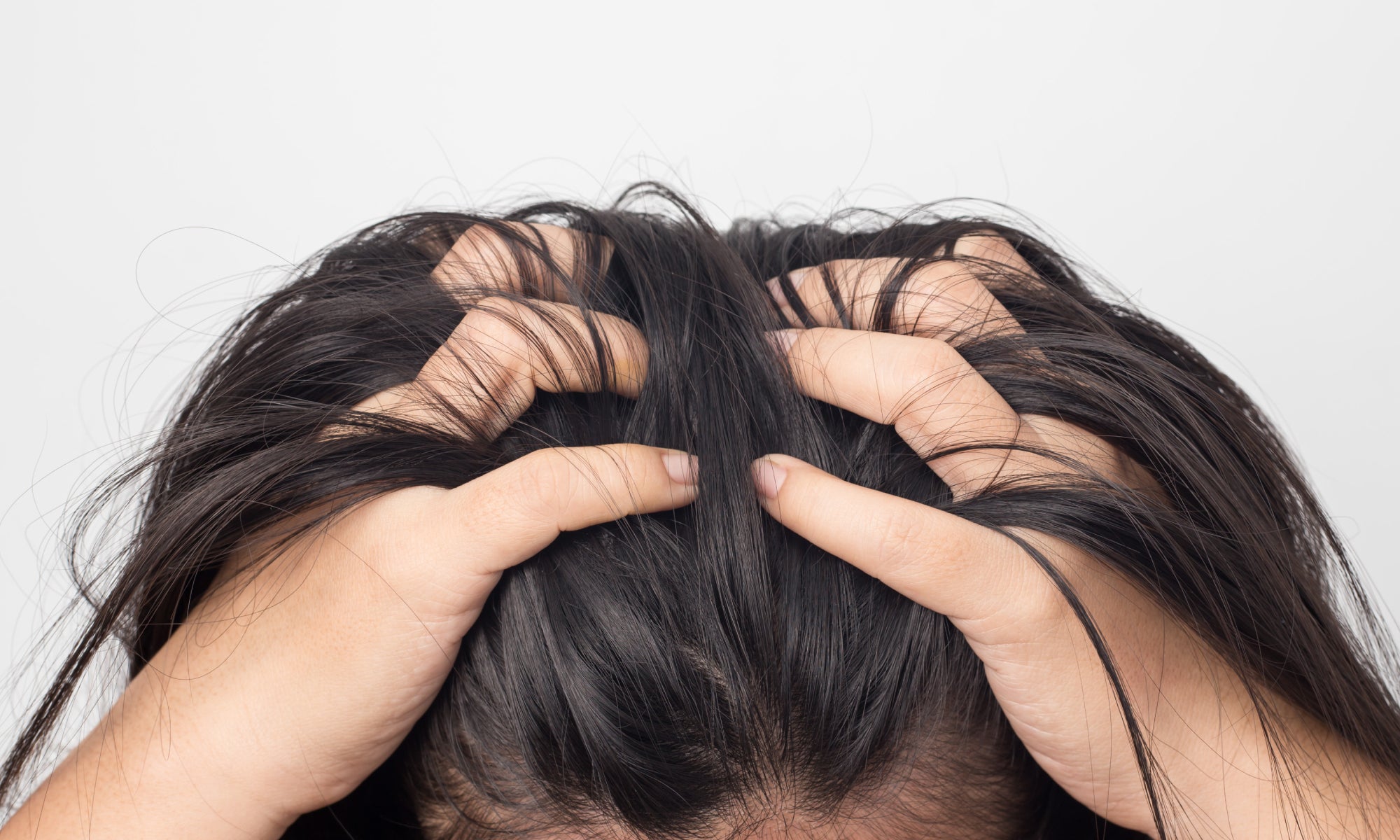 Top 5 Triggers Of Scalp Psoriasis 