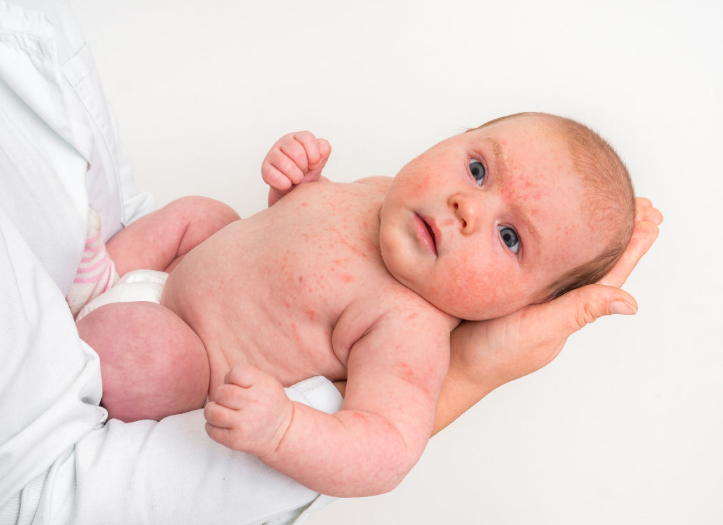 a baby with eczema