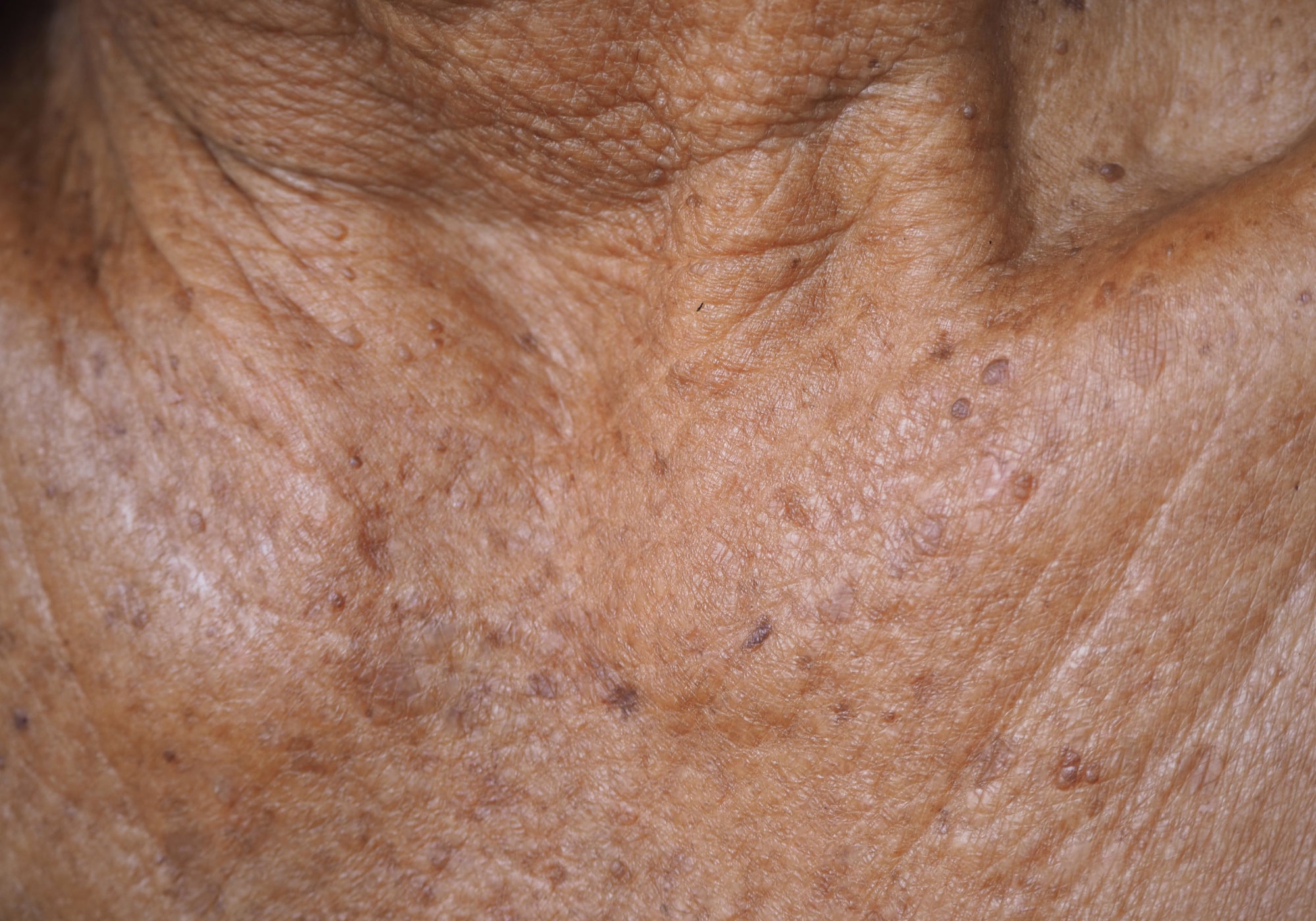 Example of Actinic Keratosis around the neck 