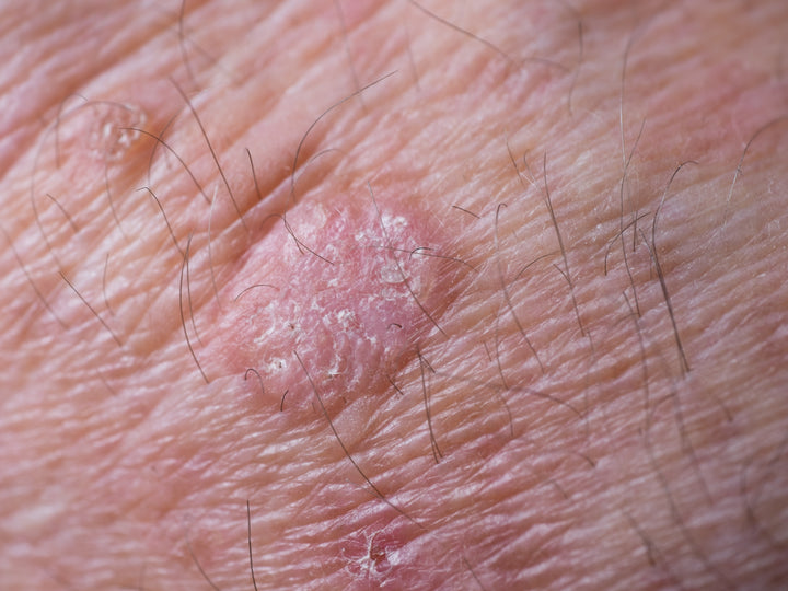 an example of keratosis on the skin