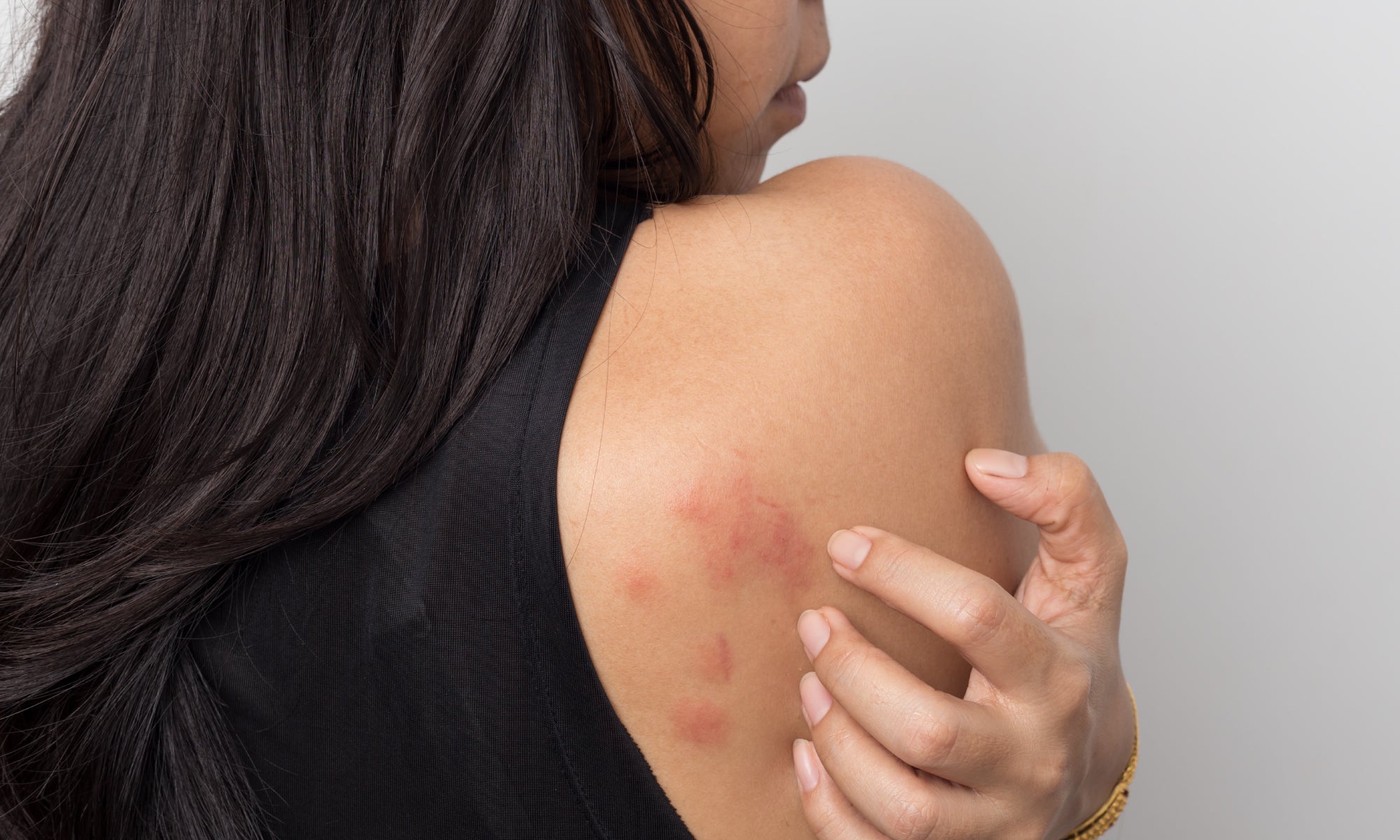 What Does Stress Rash Look Like?