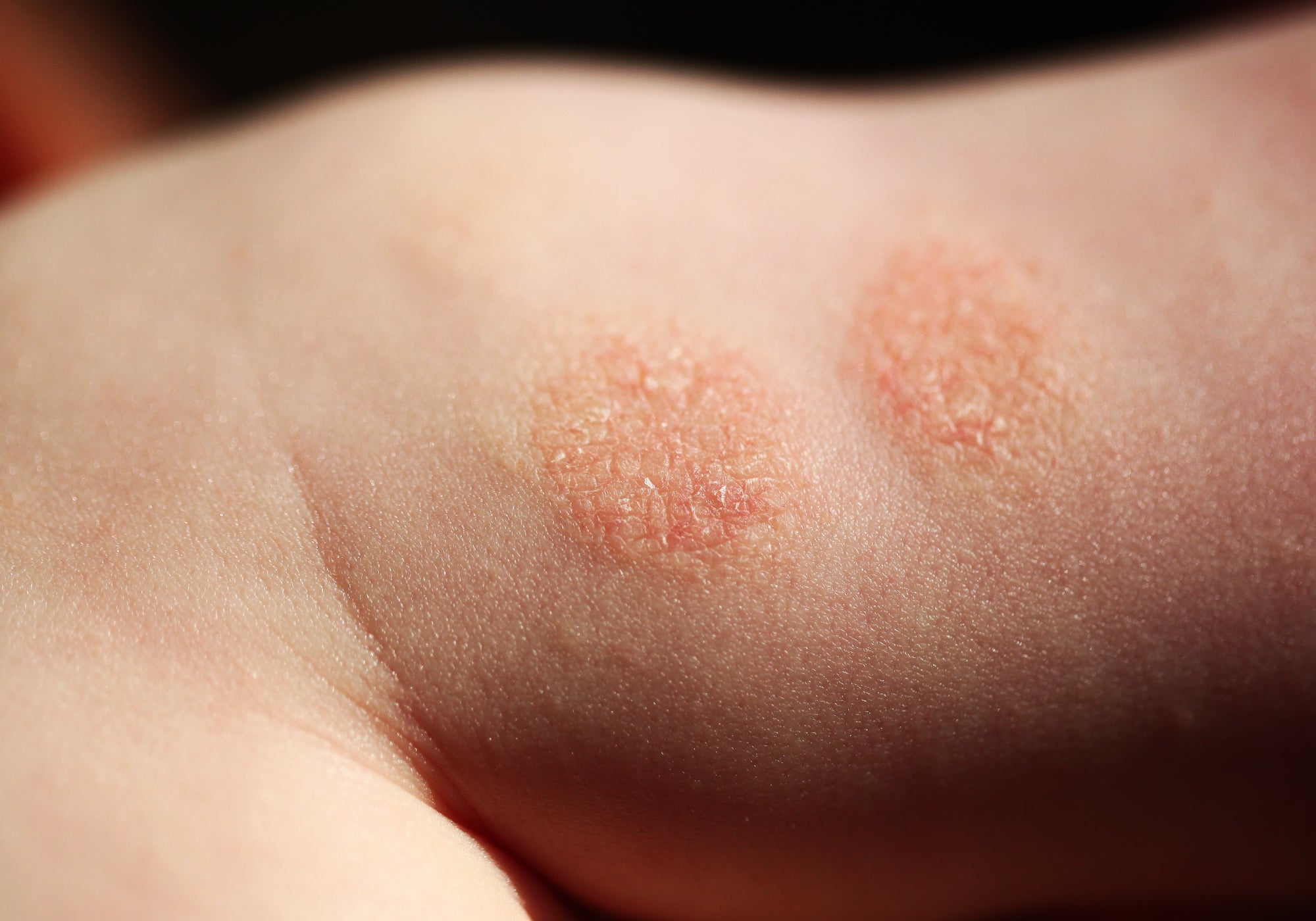 An example of Discoid Dermatitis on skin