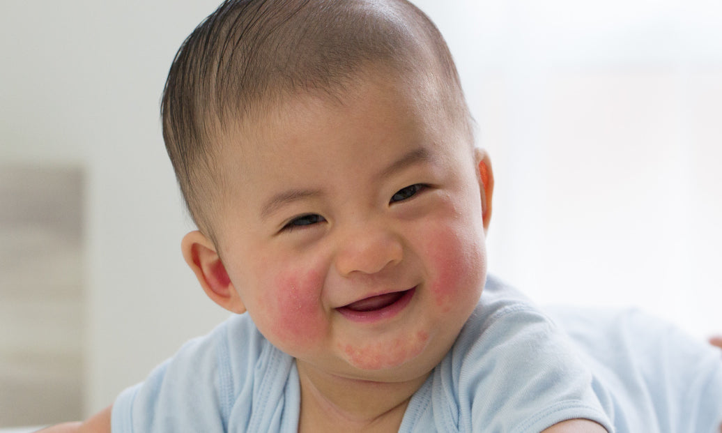 baby with eczema on cheeks