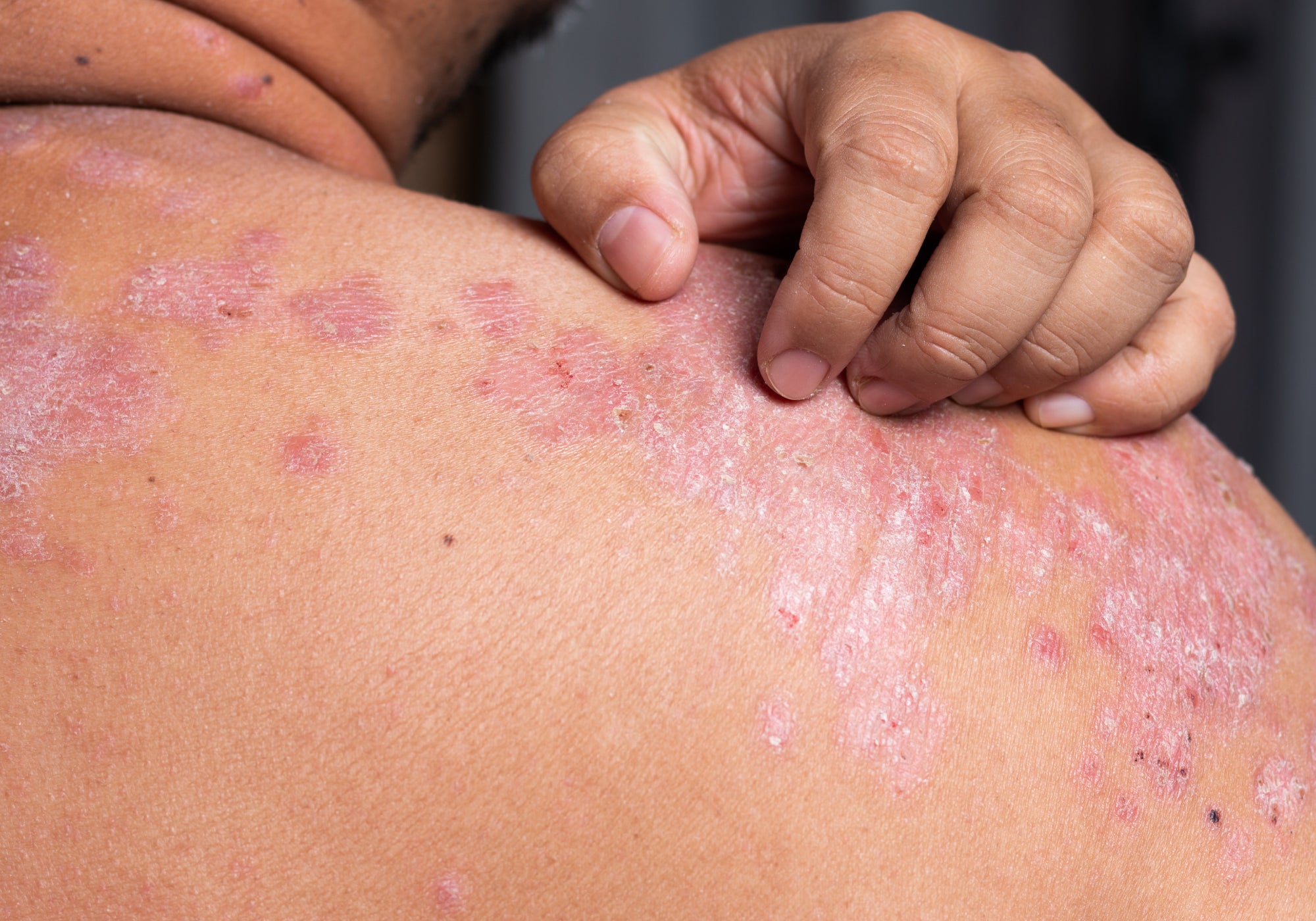 What Does Psoriasis Look Like?