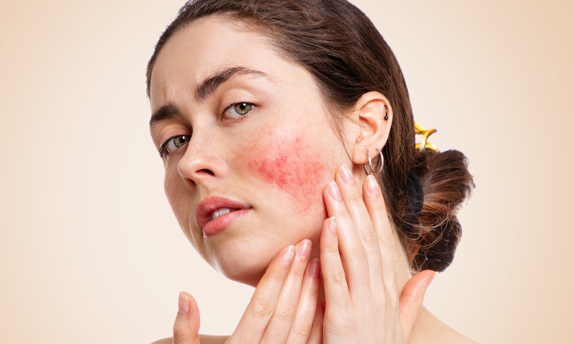 What Does Rosacea On Your Face Look Like?