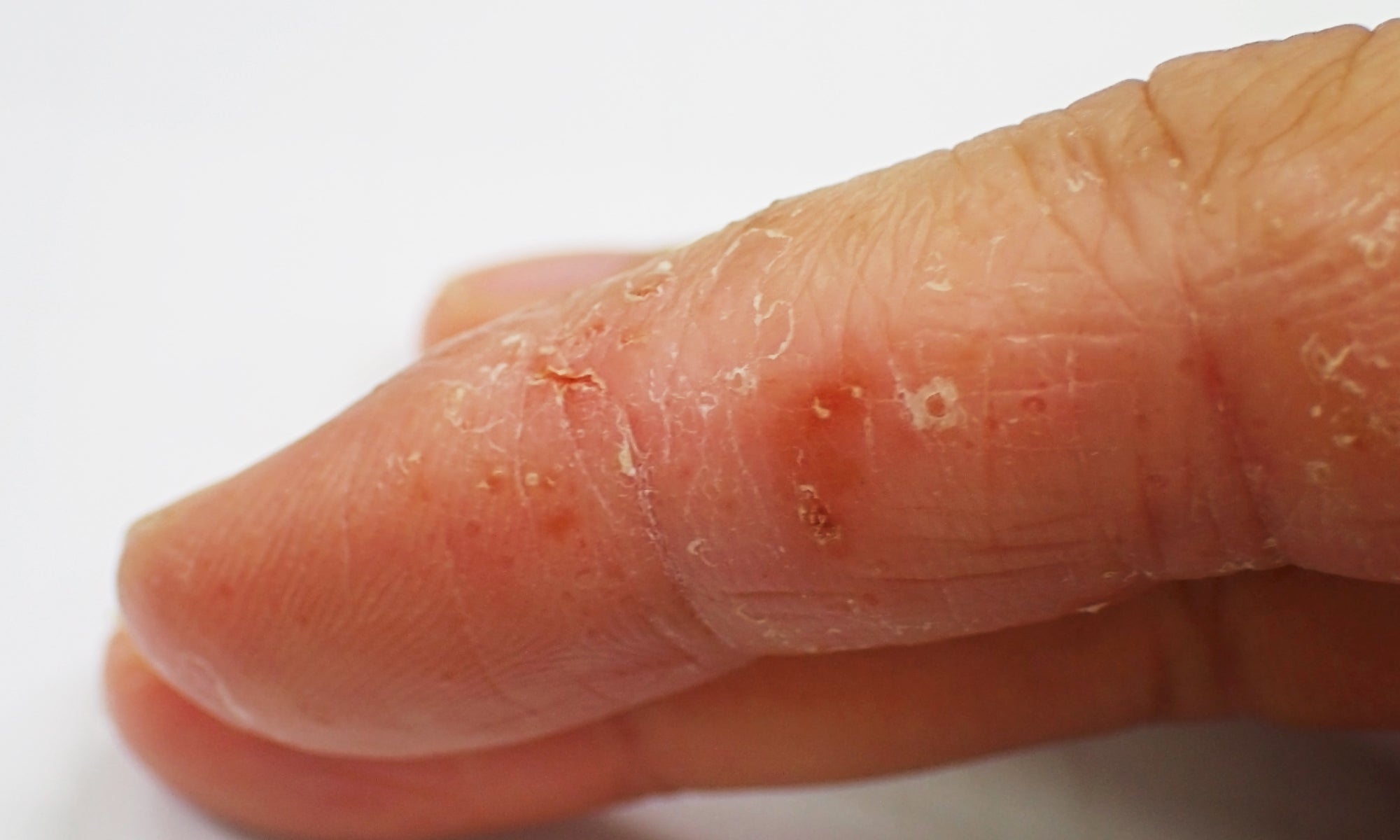 An example of Dyshidrotic Eczema on an index finger