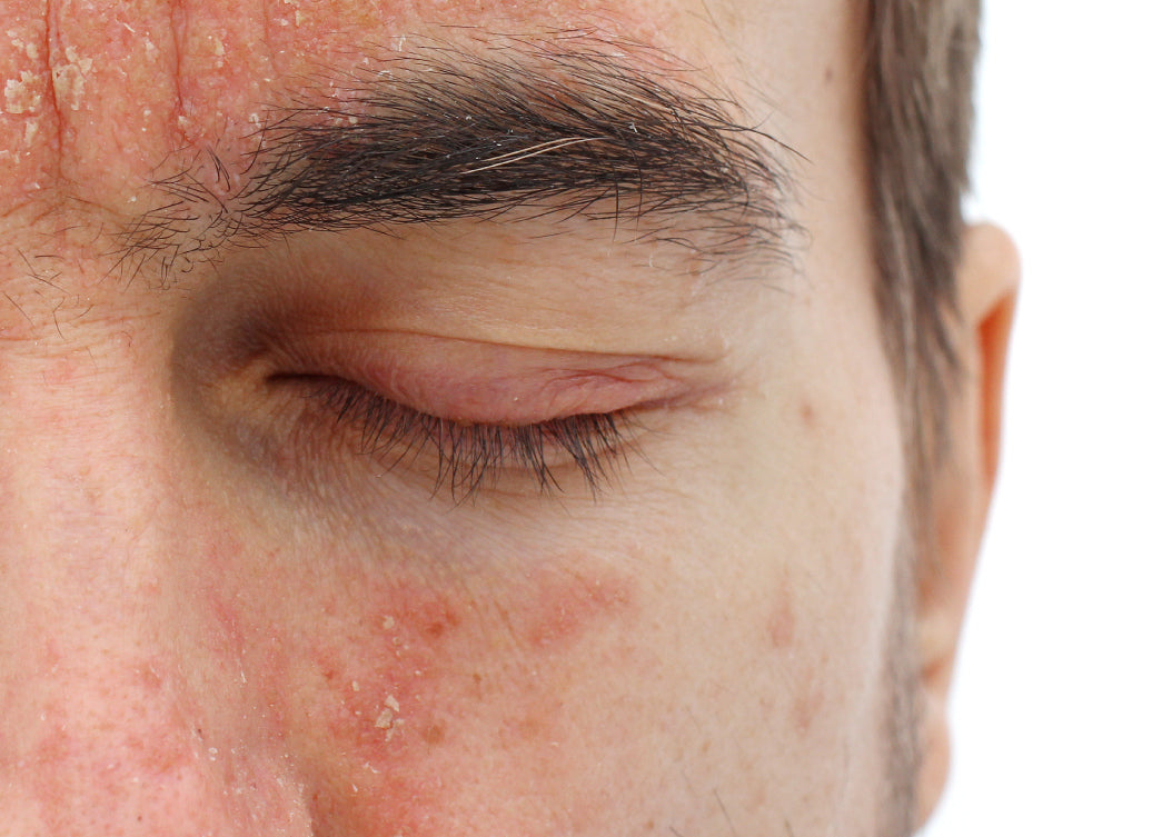 Man with periocular dermatitis