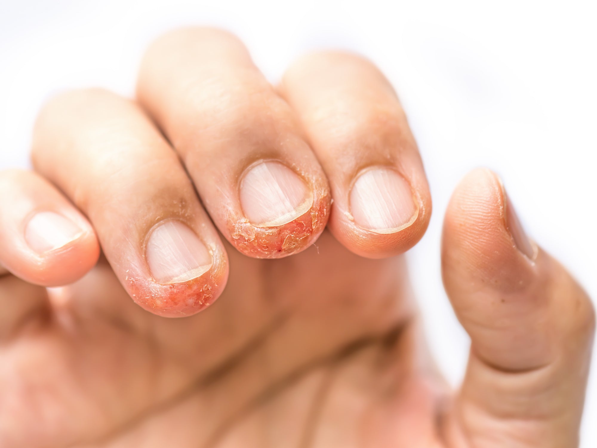 Dyshidrotic Eczema on fingers