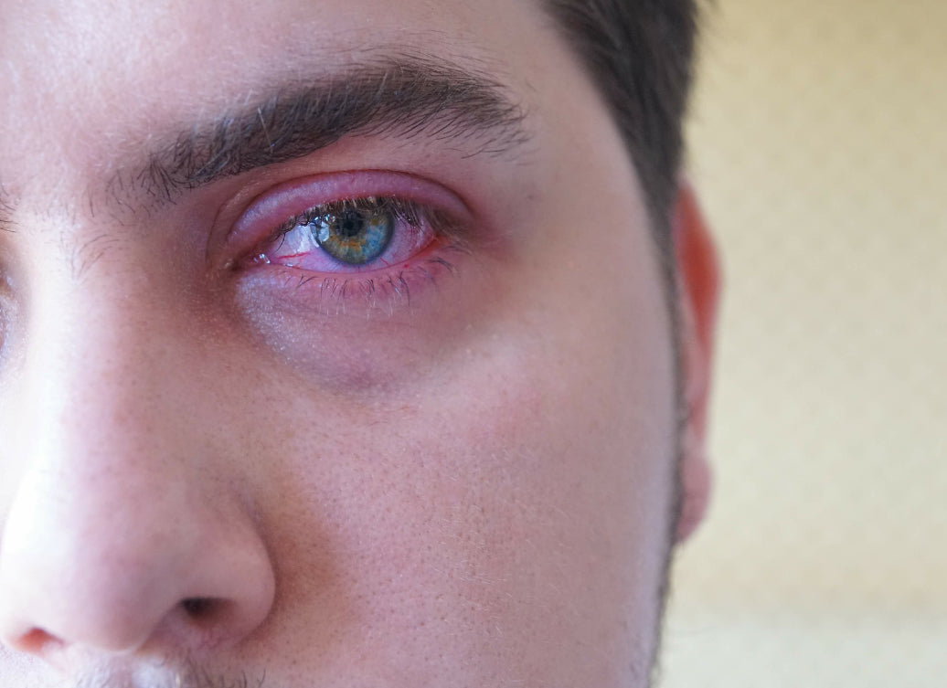 red Blepharitis around the eye