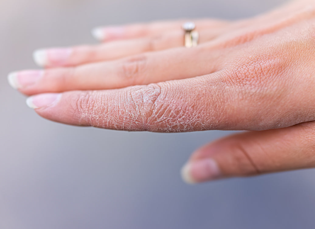 Dyshidrosis on the fingers