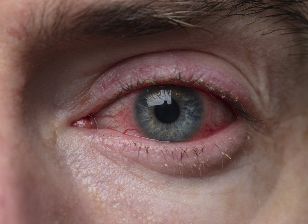 example of Blepharitis