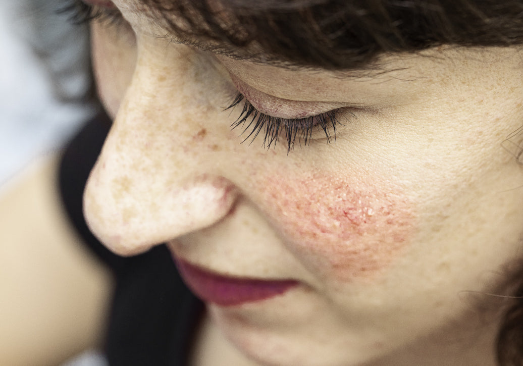 What Is The Main Cause Of Rosacea?