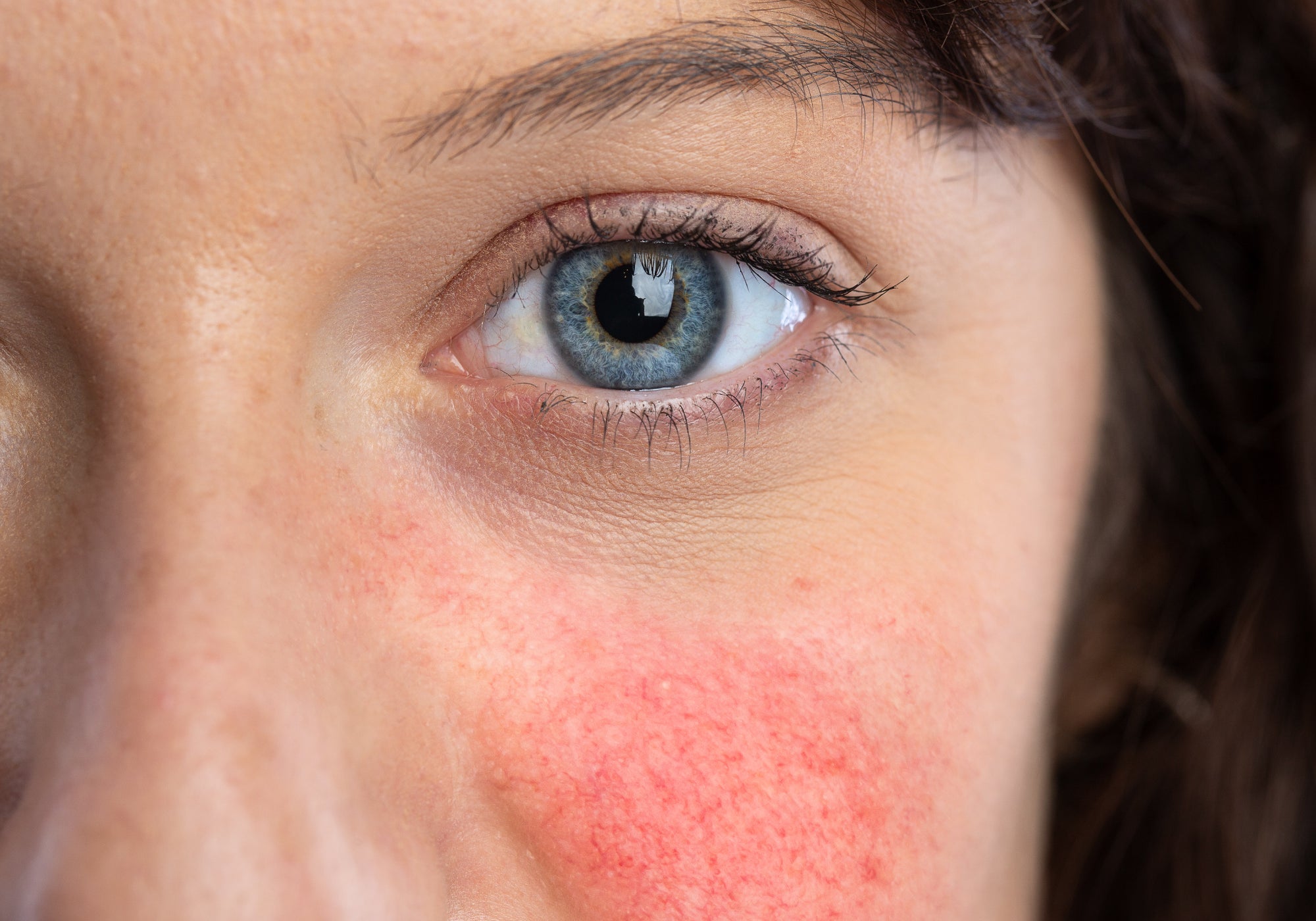 What Not To Eat When You Have Rosacea