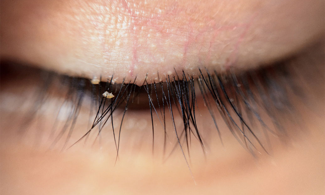 What Can Make Blepharitis Worse?