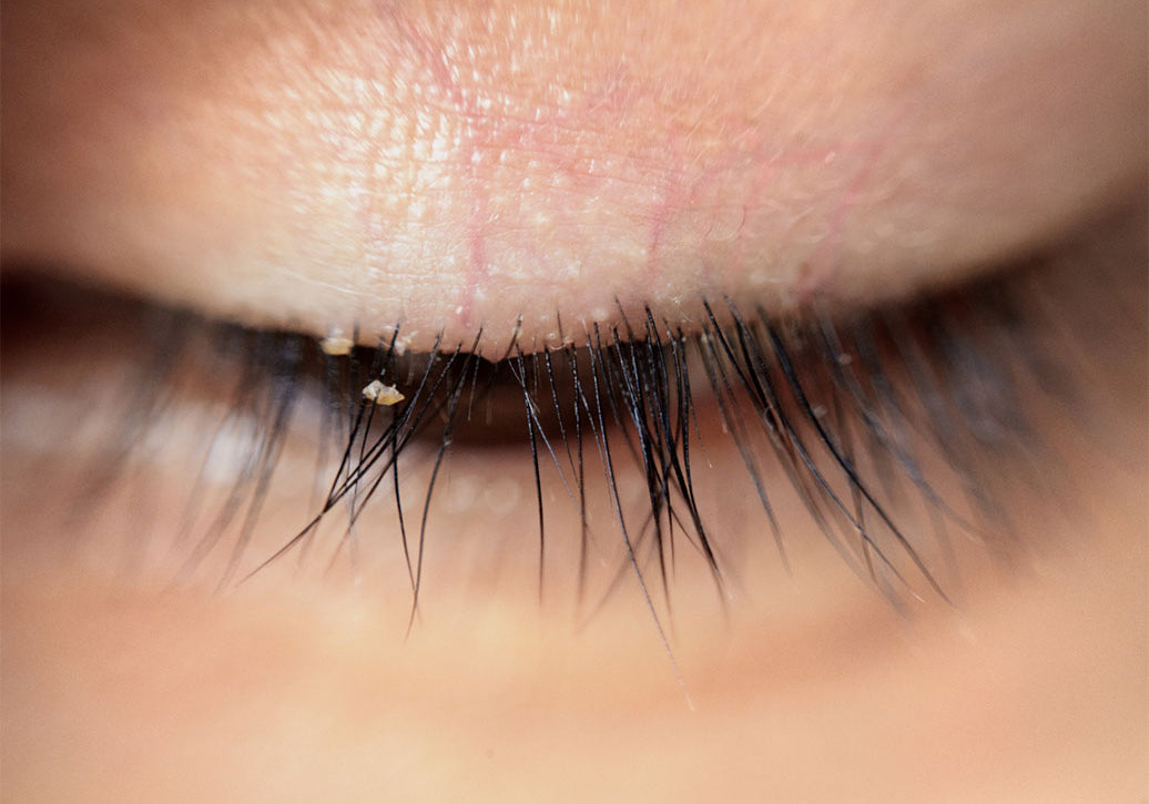 What Can Make Blepharitis Worse?