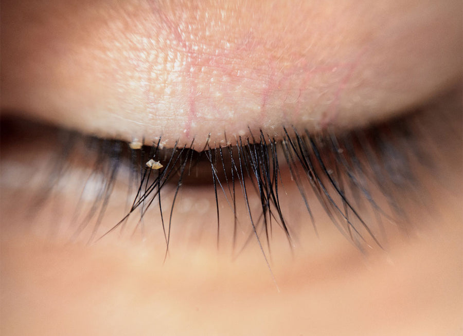 What Can Make Blepharitis Worse?
