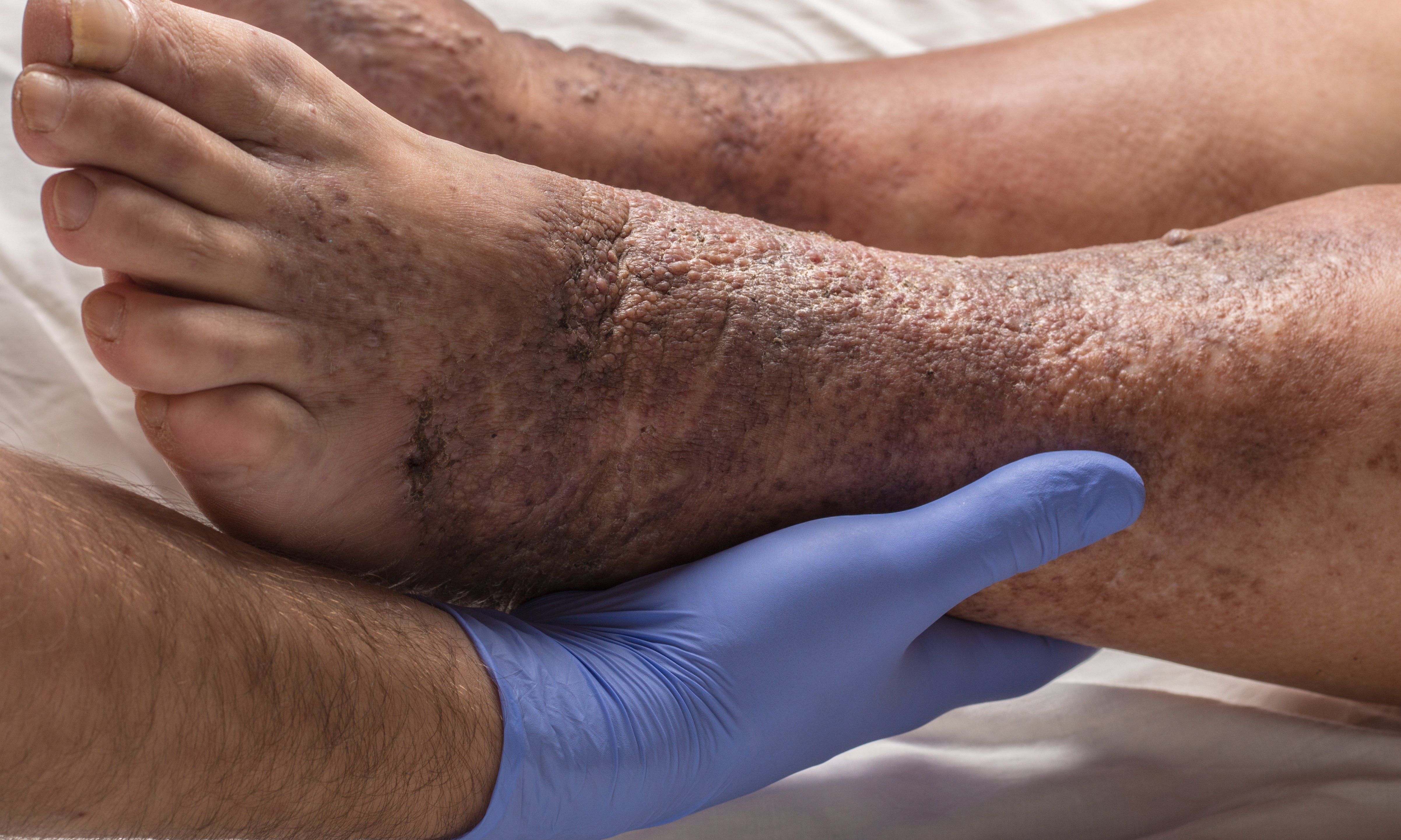 What Does Venous Stasis Dermatitis Look Like?