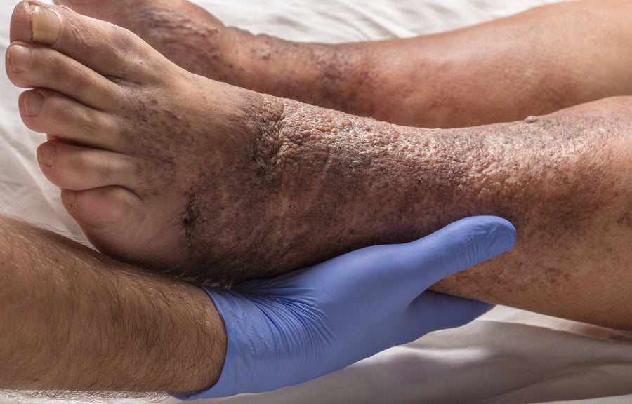 What Does Venous Stasis Dermatitis Look Like?